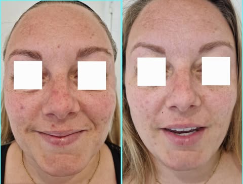 IPL Treatments