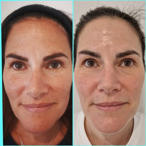 Before and after a dermaplaning treatment showing smoother skin texture