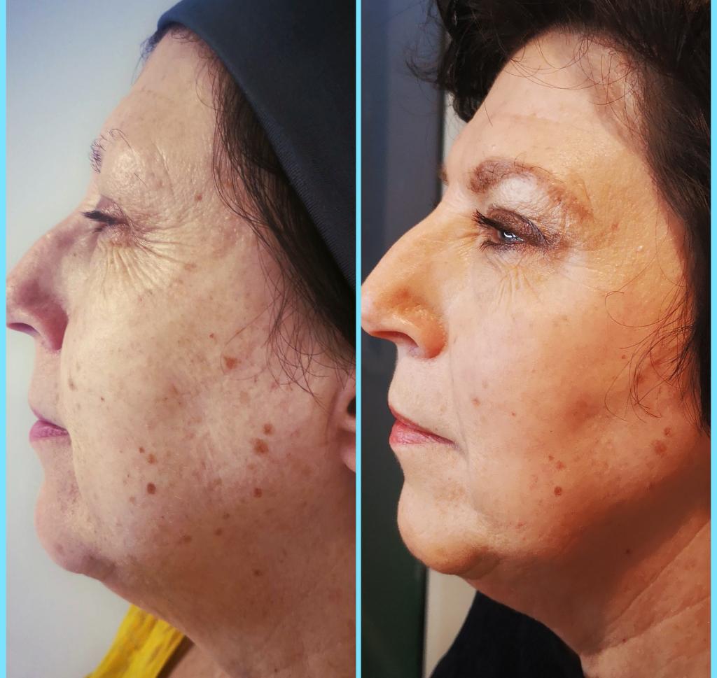 Before and after Anti-Wrinkle Treatment showing reduction in crow's feet