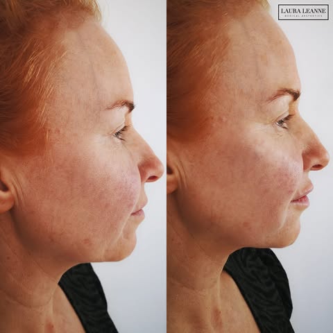 Before and after dermal filler treatment showing restored volume in the cheeks