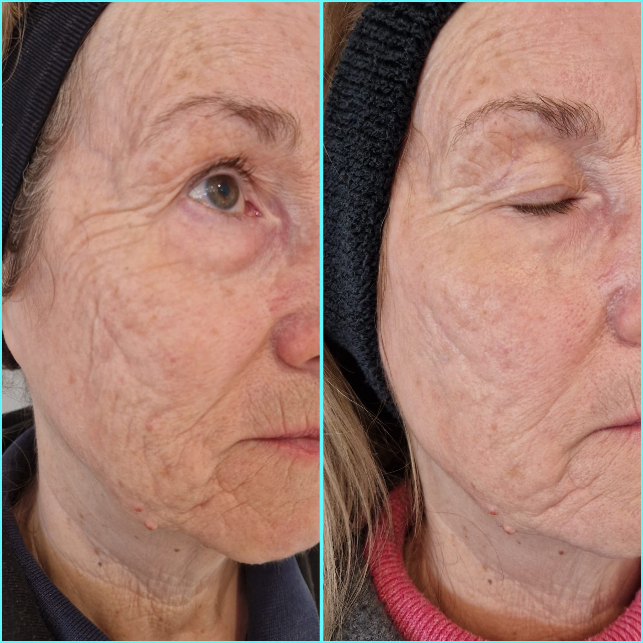 Before and after Trifractional Needling showing improved skin texture