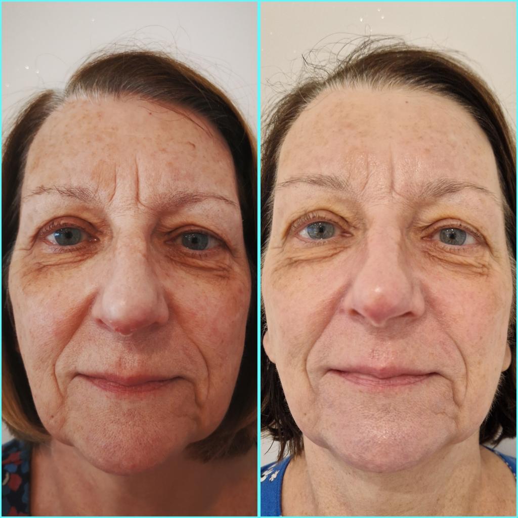 A client receiving a No Peel Peel treatment