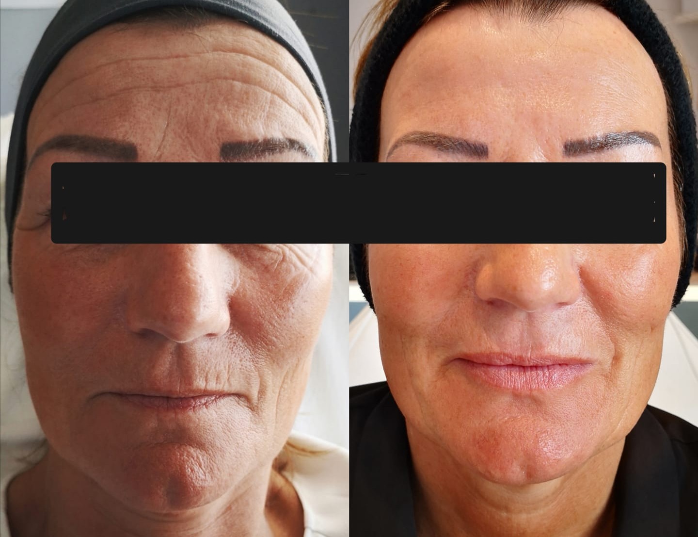 Skin rejuvenation journey with regular skin resurfacing, anti-wrinkle, and volume replacement treatments