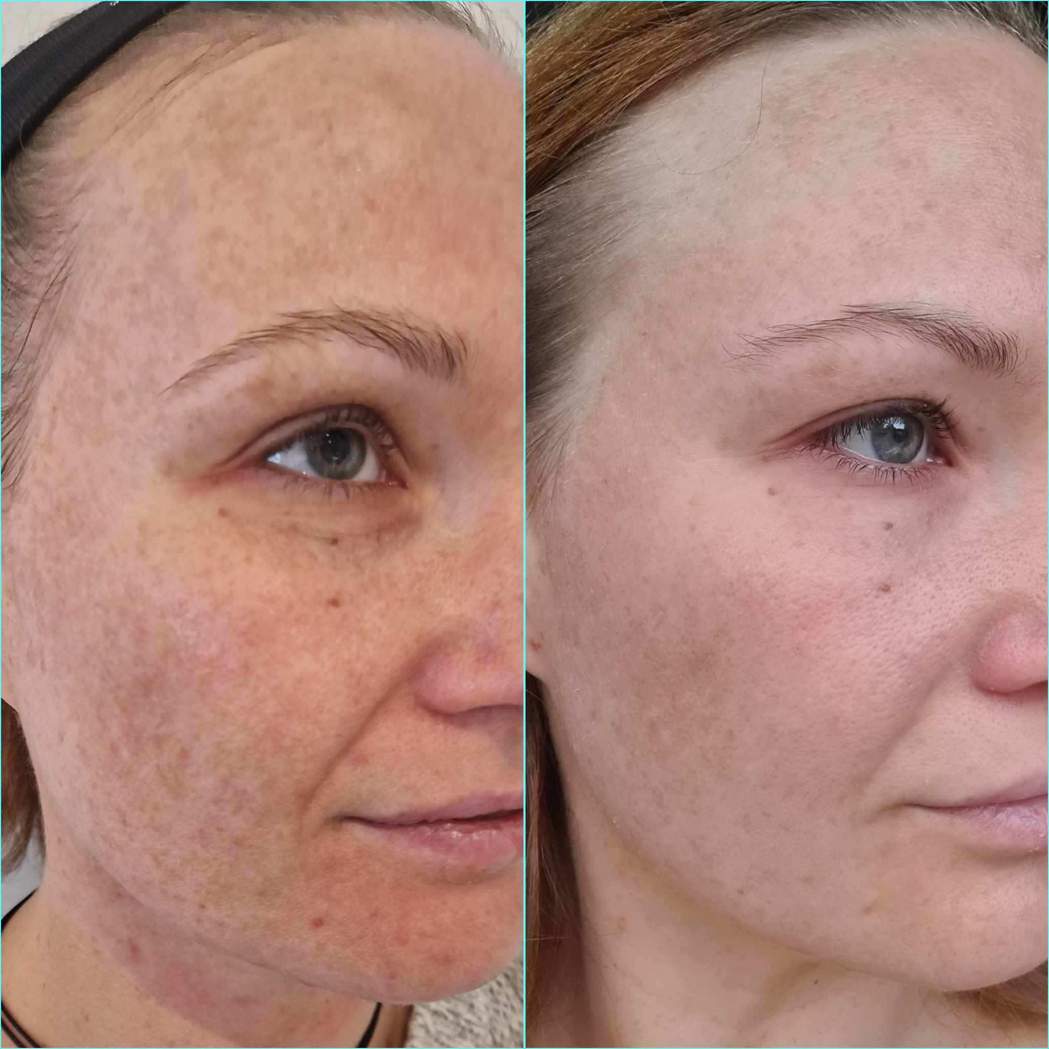 This patient received full-face dermal filler rejuvenation