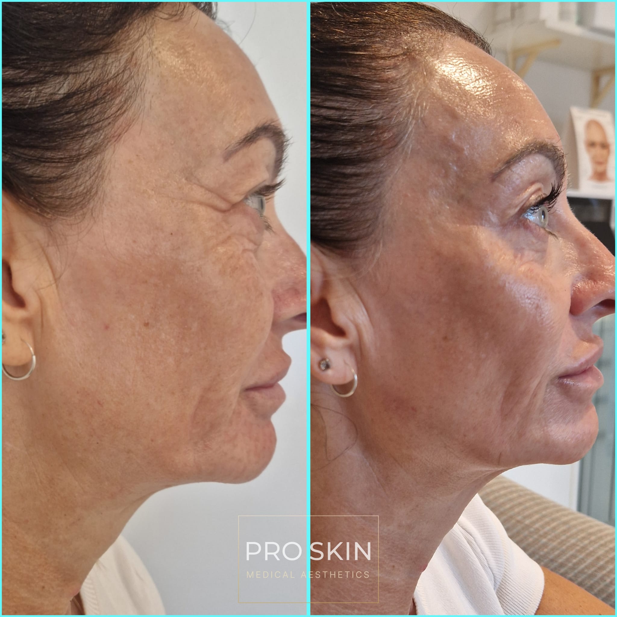 Before and after Anti-Wrinkle Treatment showing reduction in crow's feet
