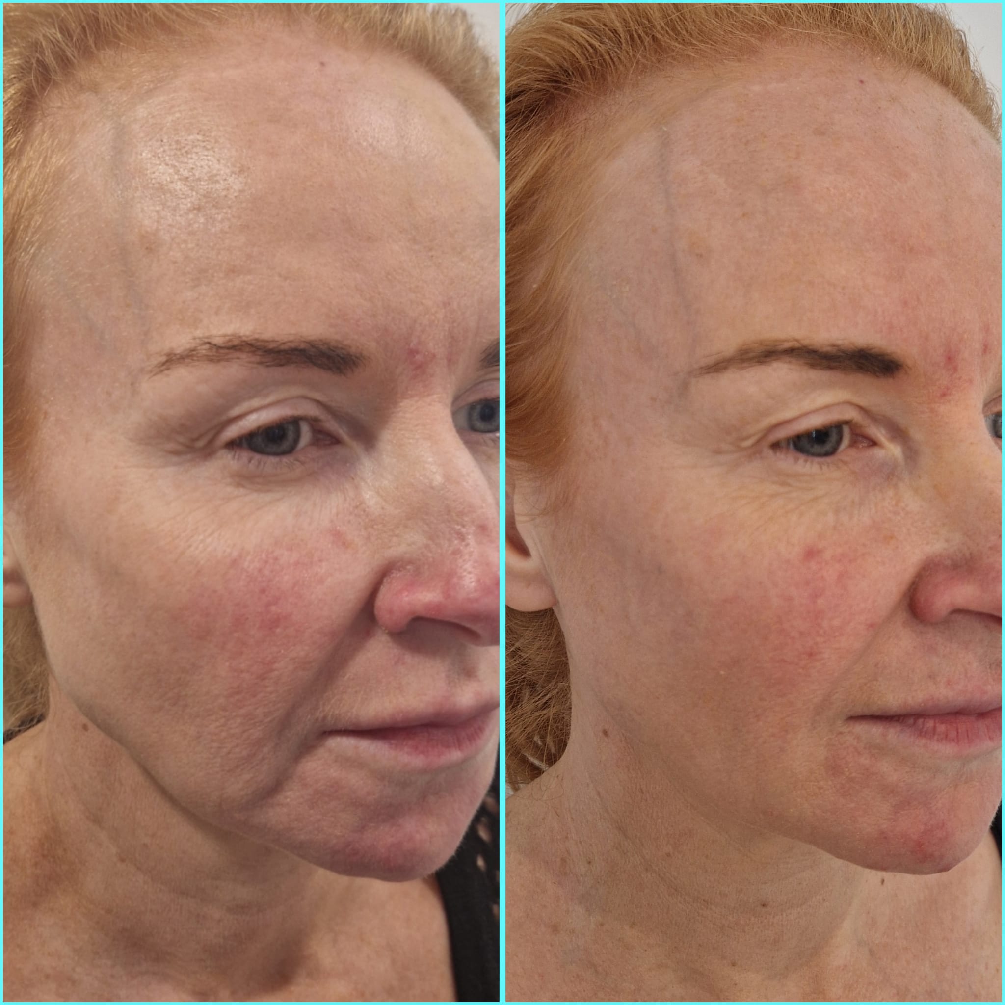 Diagram illustrating the effect of Profhilo Structura on deep facial tissues