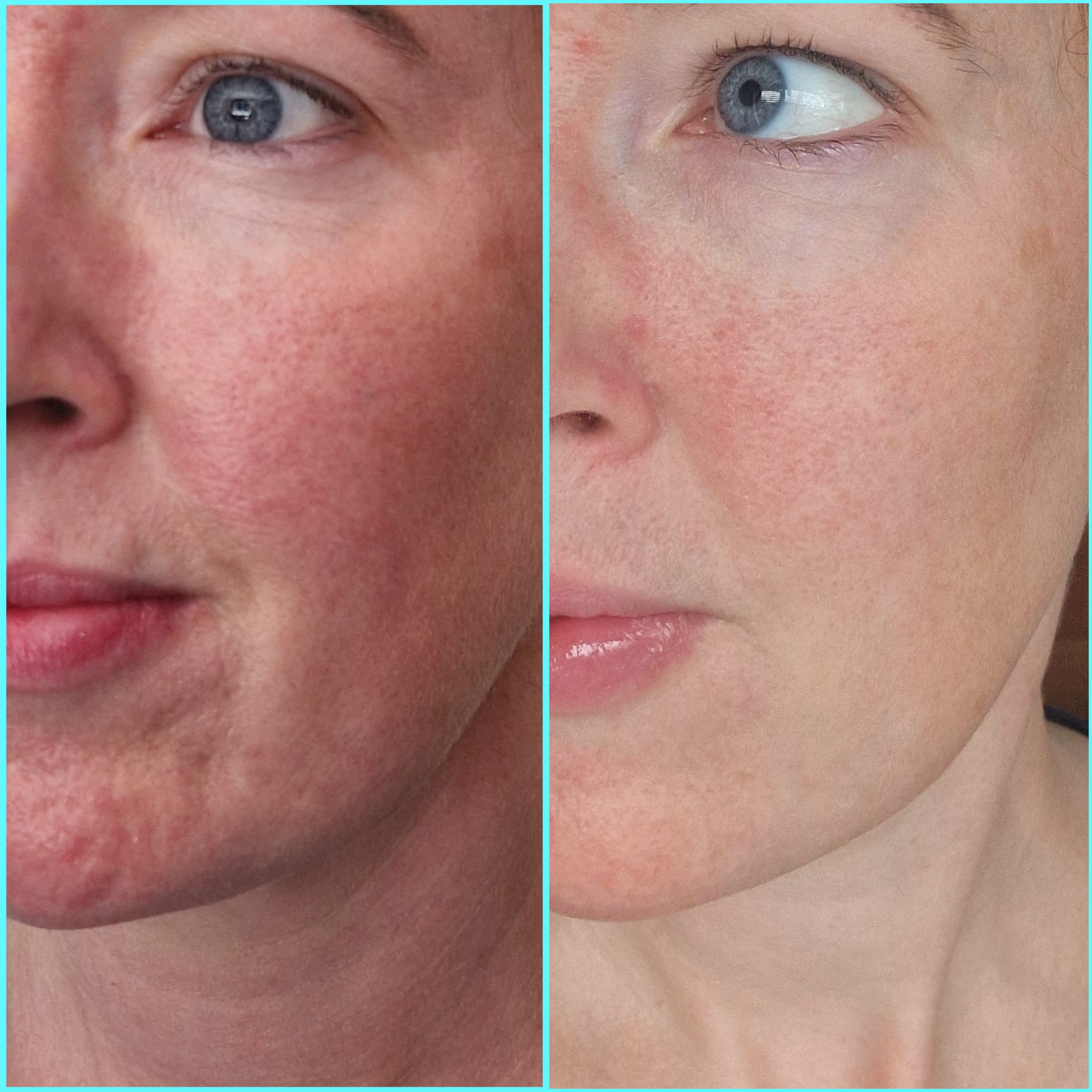 Before and after Sunekos treatment showing improved skin elasticity and hydration