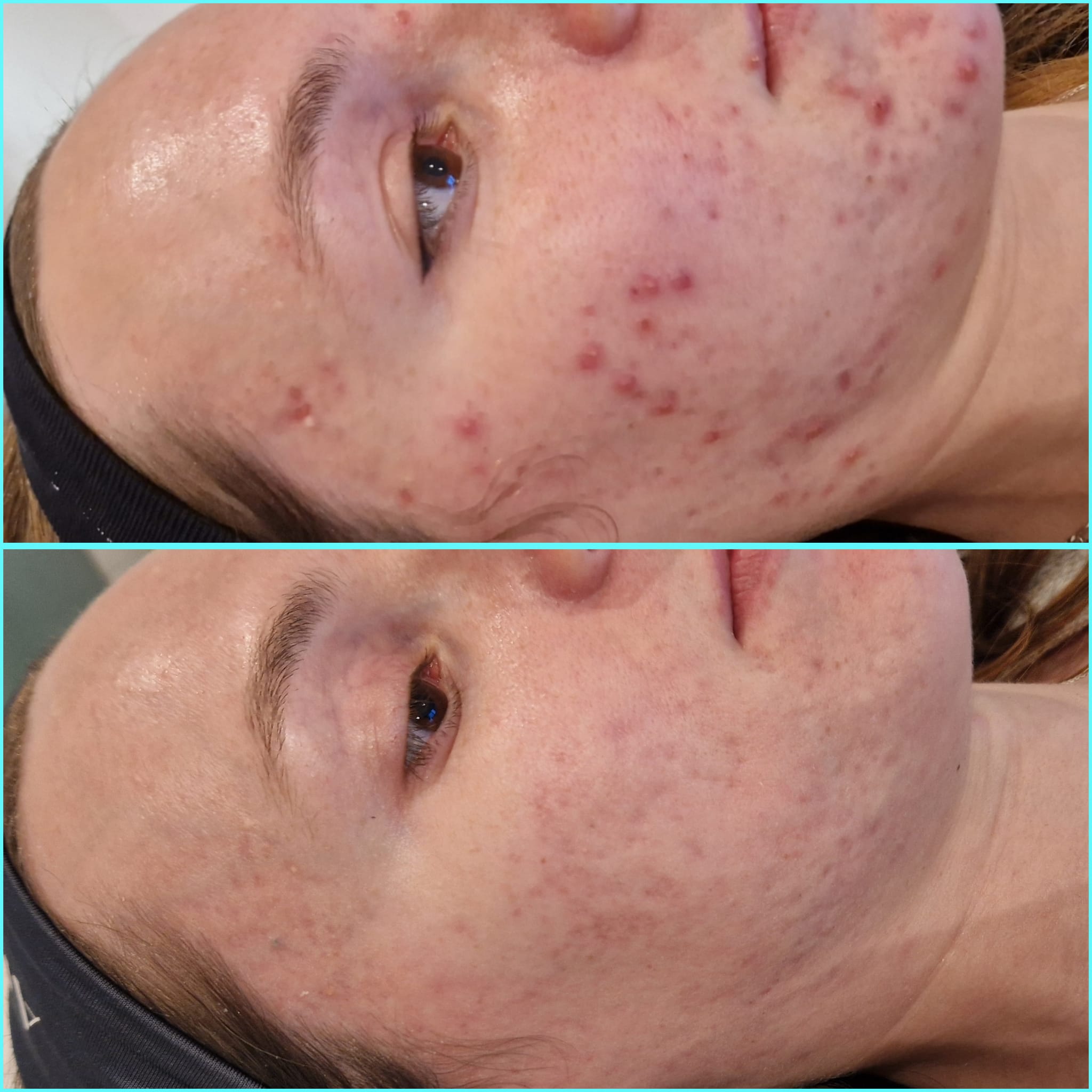 This patient received full-face dermal filler rejuvenation