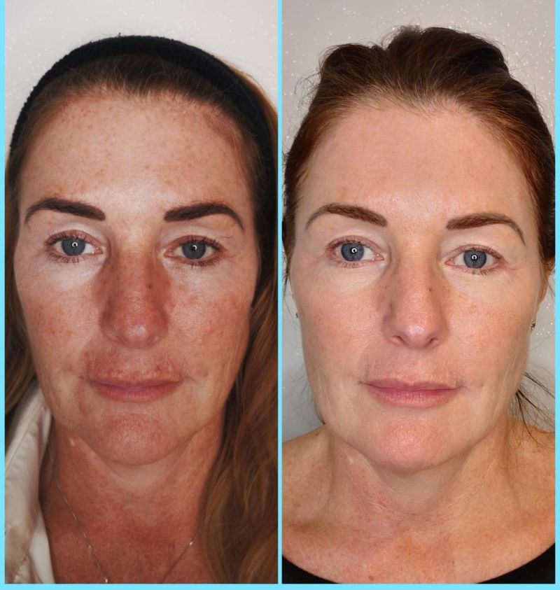 Before and after polynucleotide treatment showing improved under-eye skin texture