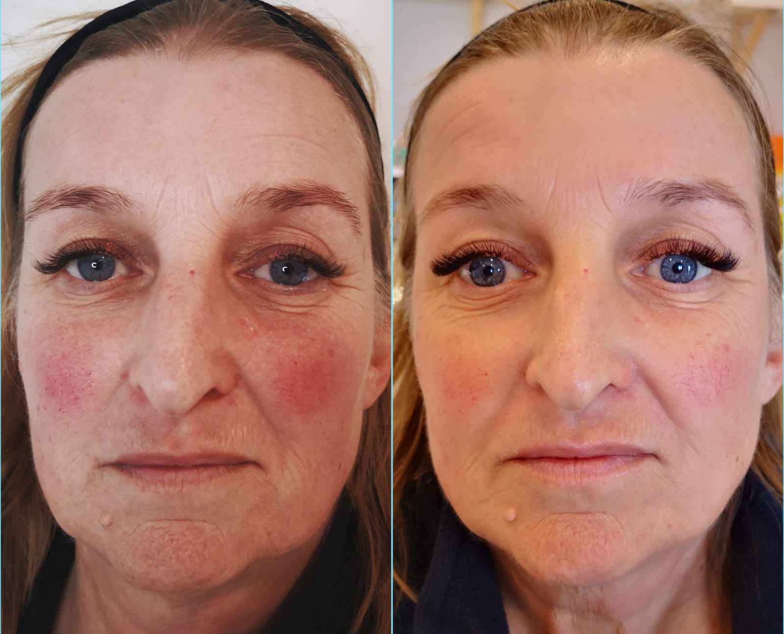 Treatment for Redness, Rosacea, Sensitivity